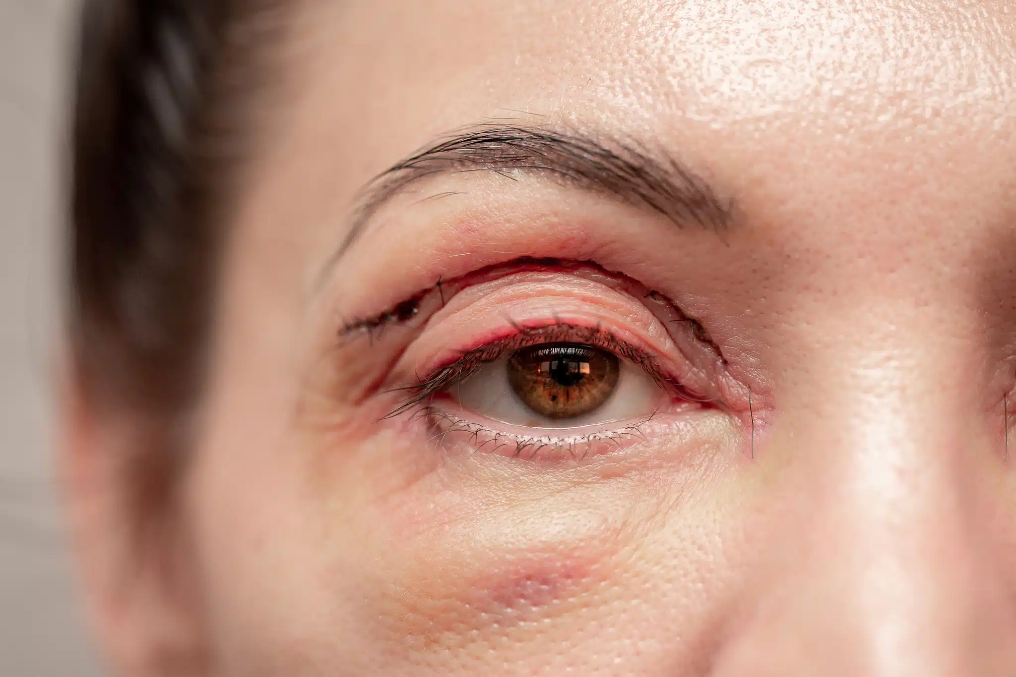 Blépharoplastie paupières